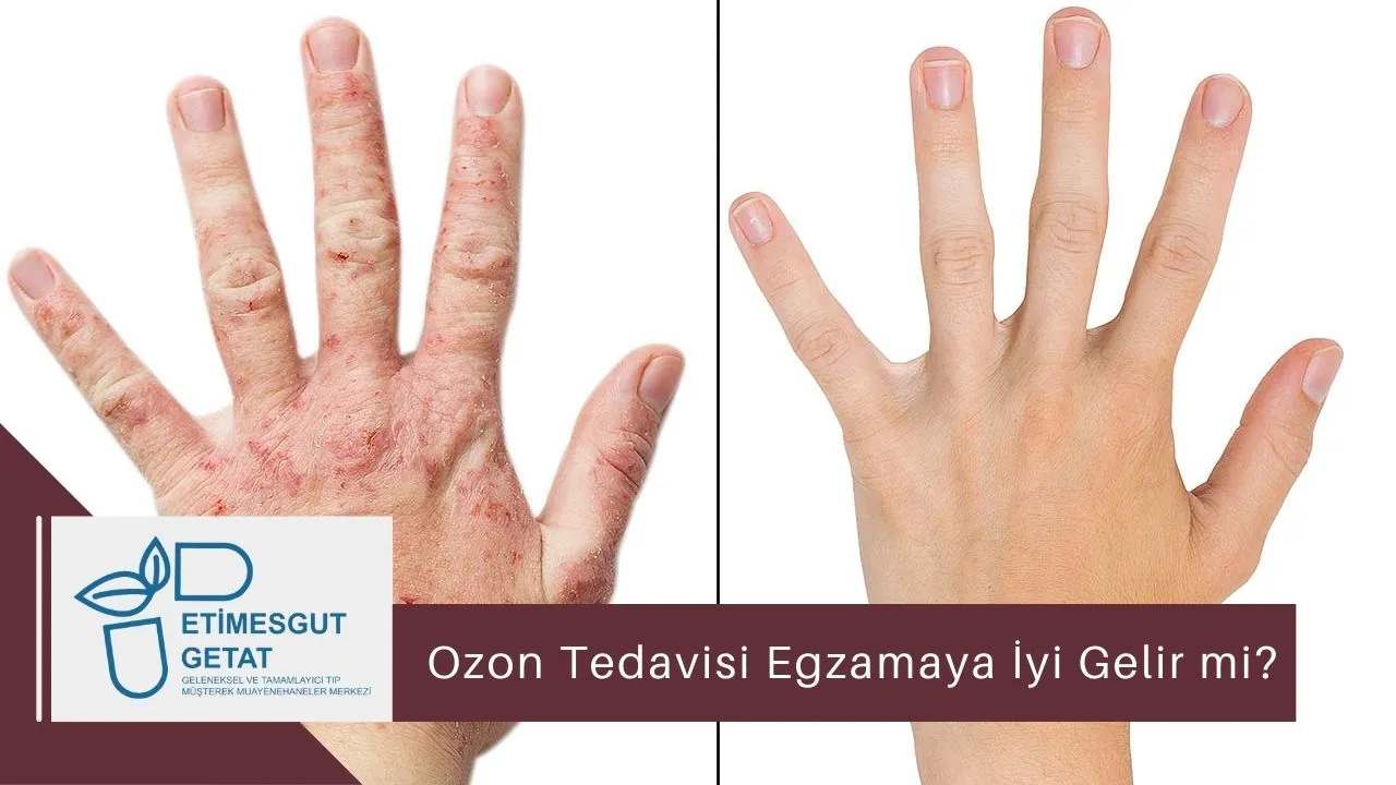 Ozon Tedavisi Egzamaya İyi Gelir mi?