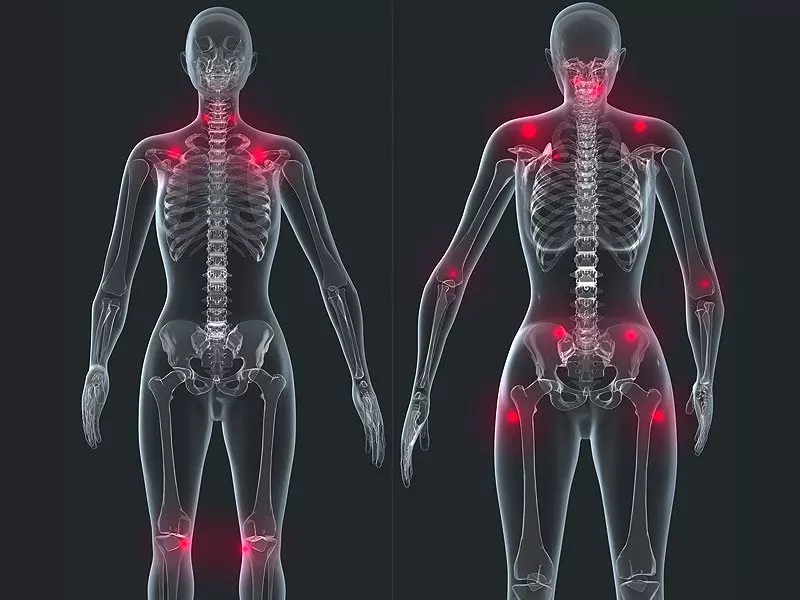 fibromiyaljide fizik tedavi